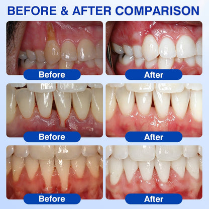 👨‍⚕️☀️🇨🇦🦷Evolvion® GumRevive Periodontal Repair Gel（upsell）