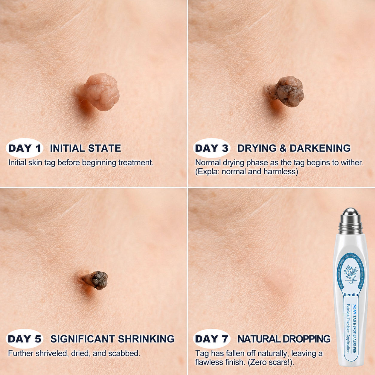 Remifa®👩‍⚕️☀️ 7-𝐷𝑎𝑦 𝗧𝐚𝐠 & 𝗦𝗽𝐨𝐭 𝐄𝐫𝒂𝒔𝒆𝒓🪄(Zero Pain, Zero 𝐒𝐜𝐚𝒓𝒔 Rollerball)⭐
