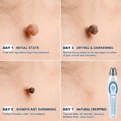 Remifa®👩‍⚕️☀️ 7-𝐷𝑎𝑦 𝗧𝐚𝐠 & 𝗦𝗽𝐨𝐭 𝐄𝐫𝒂𝒔𝒆𝒓🪄(Zero Pain, Zero 𝐒𝐜𝐚𝒓𝒔 Rollerball)⭐