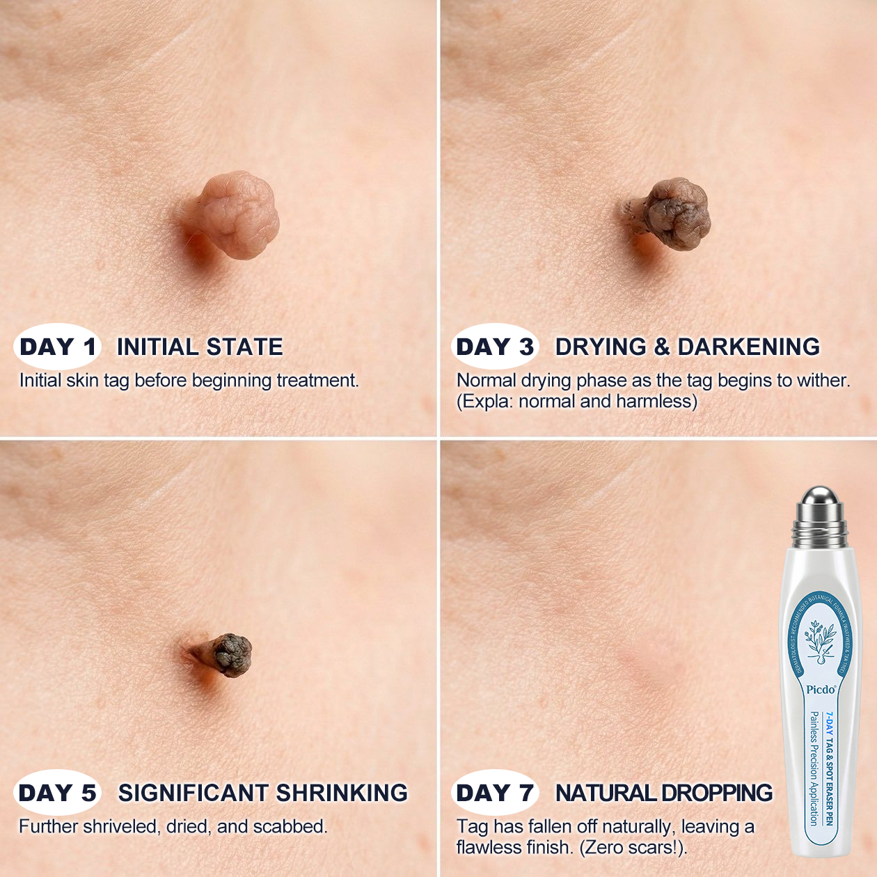 Remifa® 7-𝐷𝑎𝑦 𝗧𝐚𝐠 & 𝗦𝗽𝐨𝐭 𝐄𝐫𝒂𝒔𝒆𝒓🪄(Zero Pain, Zero 𝐒𝐜𝐚𝒓𝒔 Rollerball)⭐