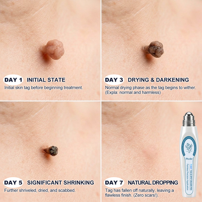 Remifa® 7-𝐷𝑎𝑦 𝗧𝐚𝐠 & 𝗦𝗽𝐨𝐭 𝐄𝐫𝒂𝒔𝒆𝒓🪄(Zero Pain, Zero 𝐒𝐜𝐚𝒓𝒔 Rollerball)⭐